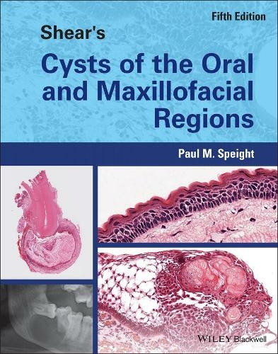 Shear's Cysts of the Oral and Maxillofacial Regions: (5th edition)